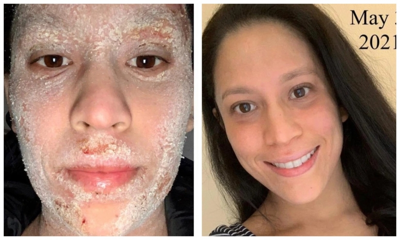 Side effect: an American woman has endured terrible suffering because of steroids to treat eczema Side effect: an American woman has endured terrible suffering because of steroids to treat eczema