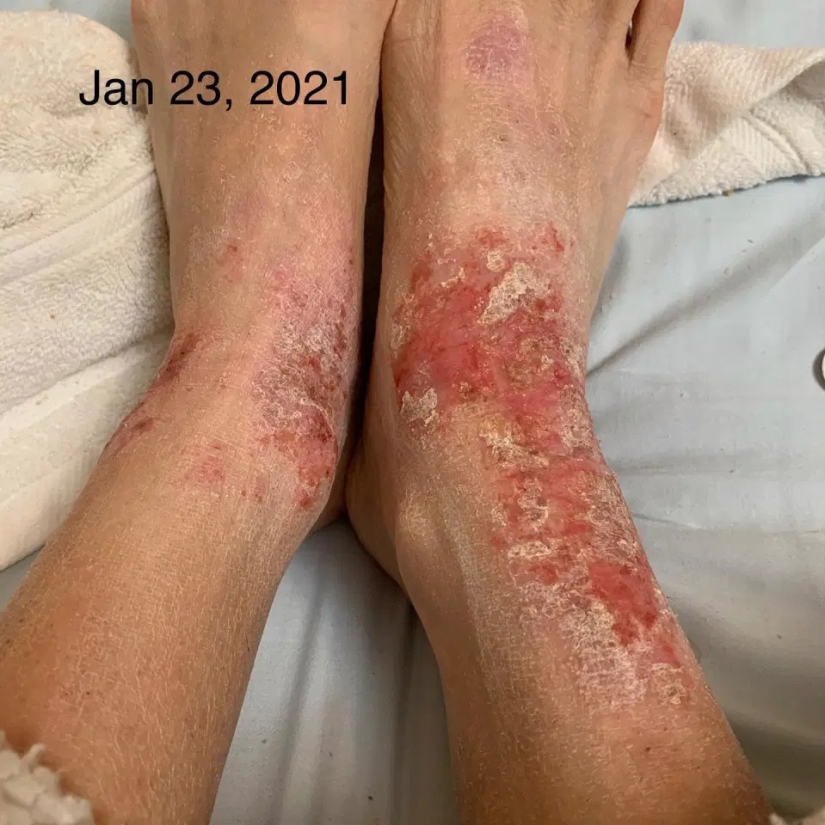 Side effect: an American woman has endured terrible suffering because of steroids to treat eczema Side effect: an American woman has endured terrible suffering because of steroids to treat eczema