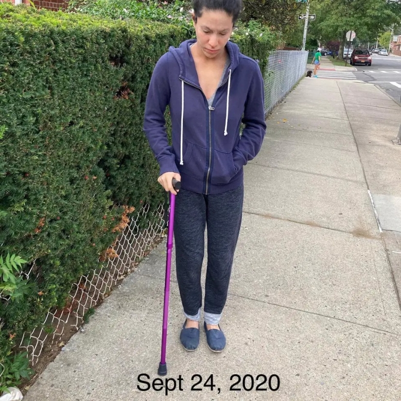 Side effect: an American woman has endured terrible suffering because of steroids to treat eczema Side effect: an American woman has endured terrible suffering because of steroids to treat eczema