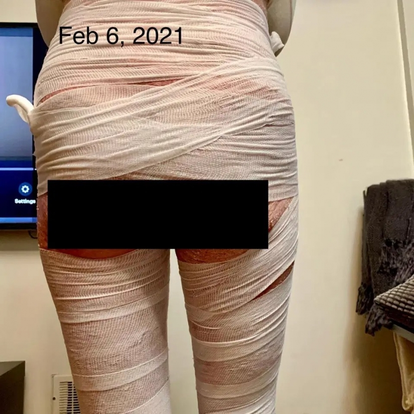 Side effect: an American woman has endured terrible suffering because of steroids to treat eczema Side effect: an American woman has endured terrible suffering because of steroids to treat eczema