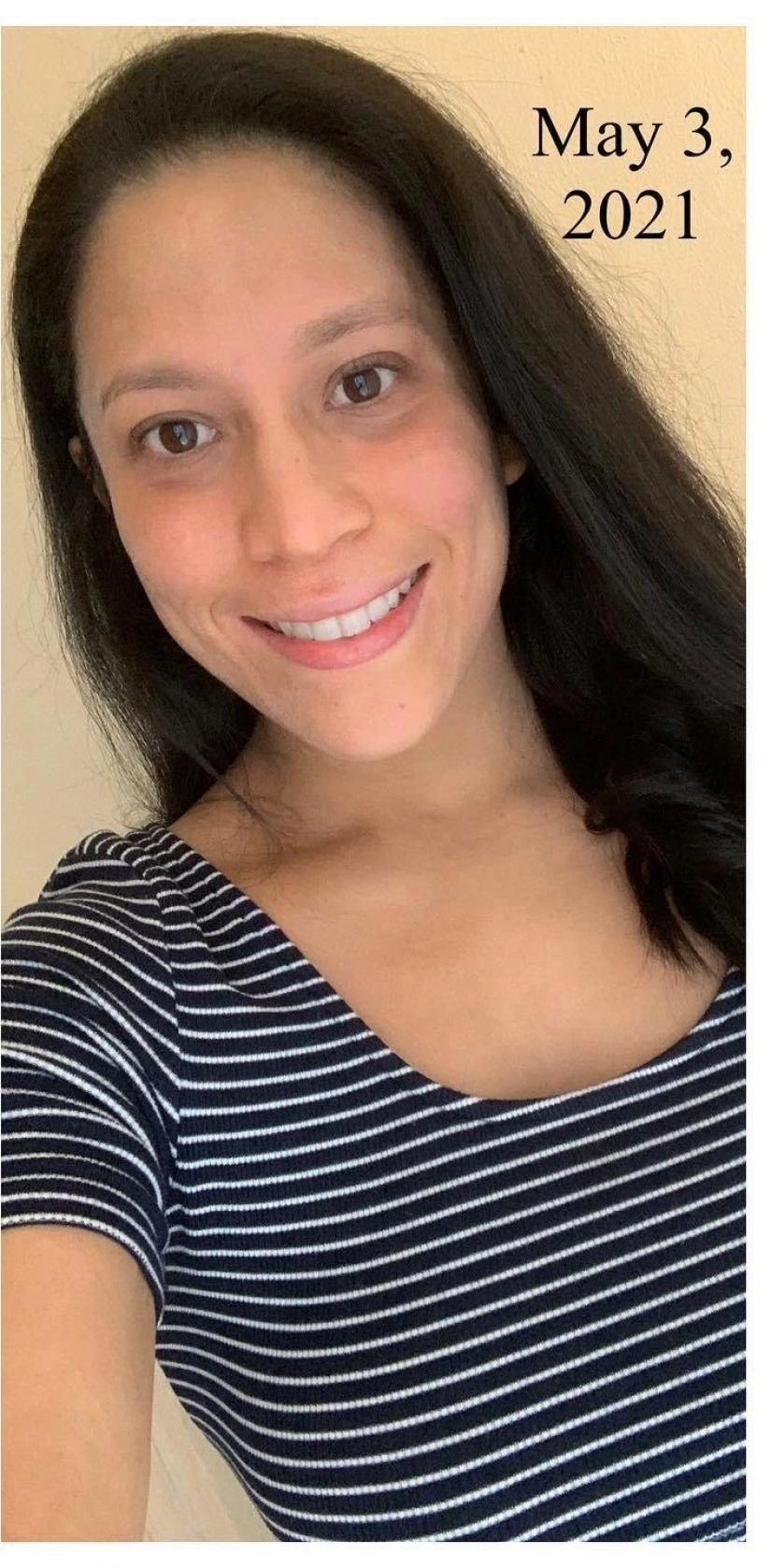 Side effect: an American woman has endured terrible suffering because of steroids to treat eczema Side effect: an American woman has endured terrible suffering because of steroids to treat eczema