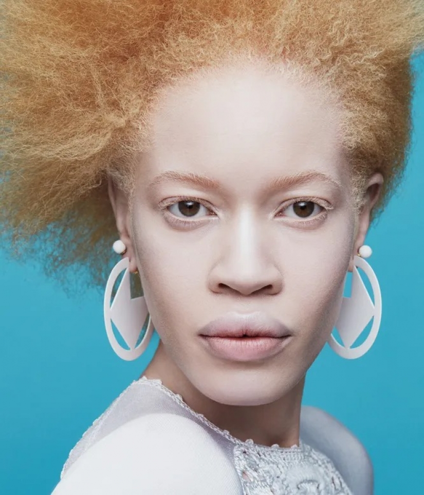 Strabismus, albinism, age: 5 models who tear the beauty template Strabismus, albinism, age: 5 models who tear the beauty template