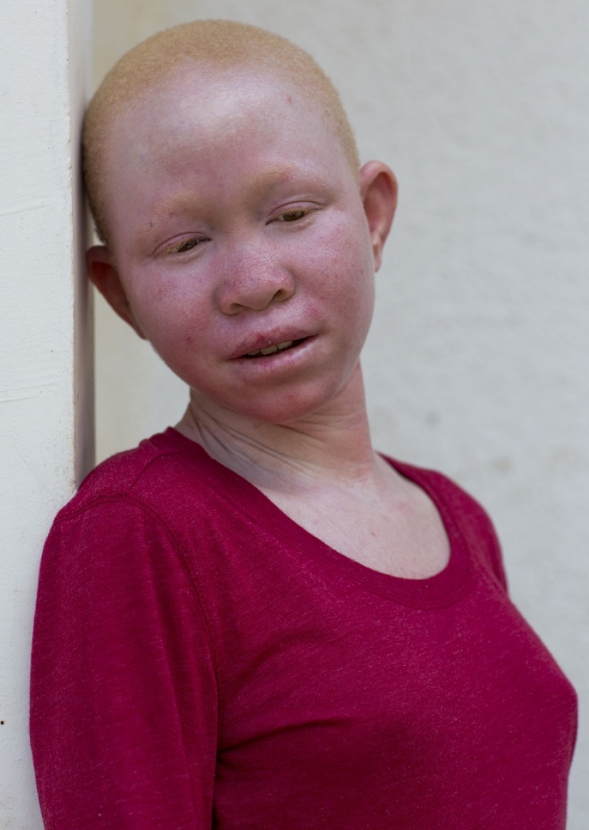 Tanzanian albinos, whose bodies are worth more than gold