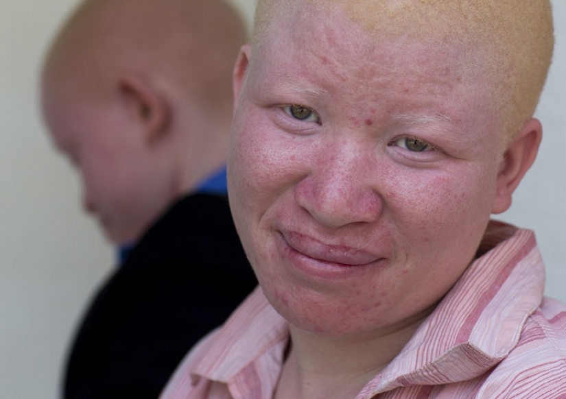 Tanzanian albinos, whose bodies are worth more than gold