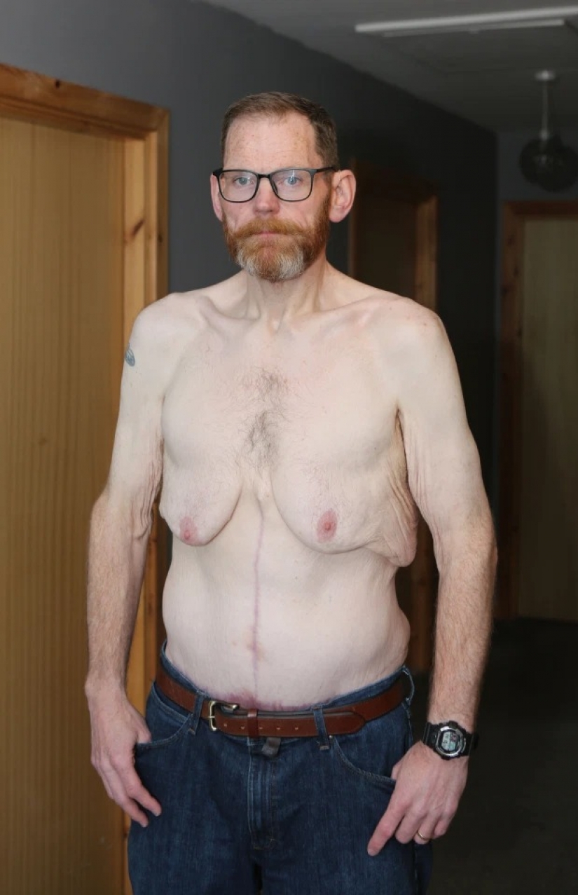 The fattest Briton lost 270 kg because he was afraid to crush his wife in bed