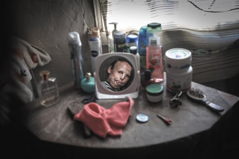 The story of Ani boldyrevoy, which has lost face because of the fire, but hopes for a better life