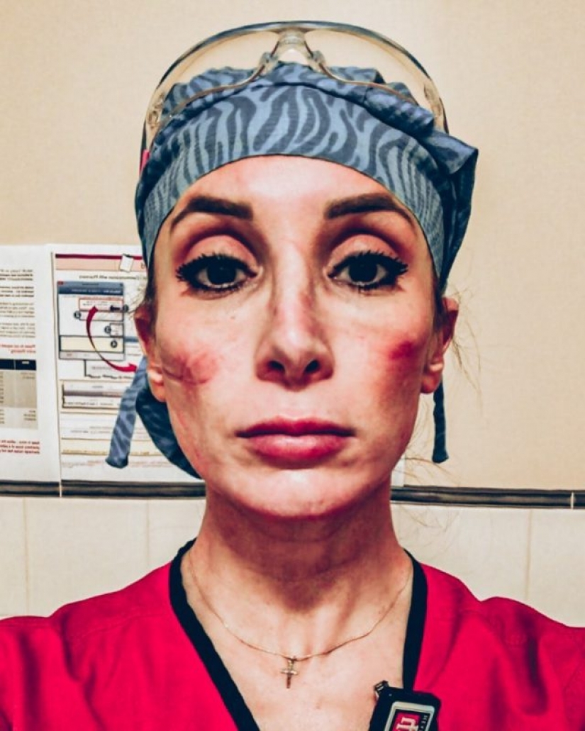 "These wounds will not go away — they will remain inside us": photos of medical girls with traces of masks on their faces