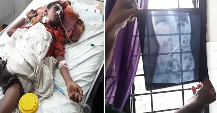 Un joven indio comía cepillos de dientes y uñas para curar la adicción