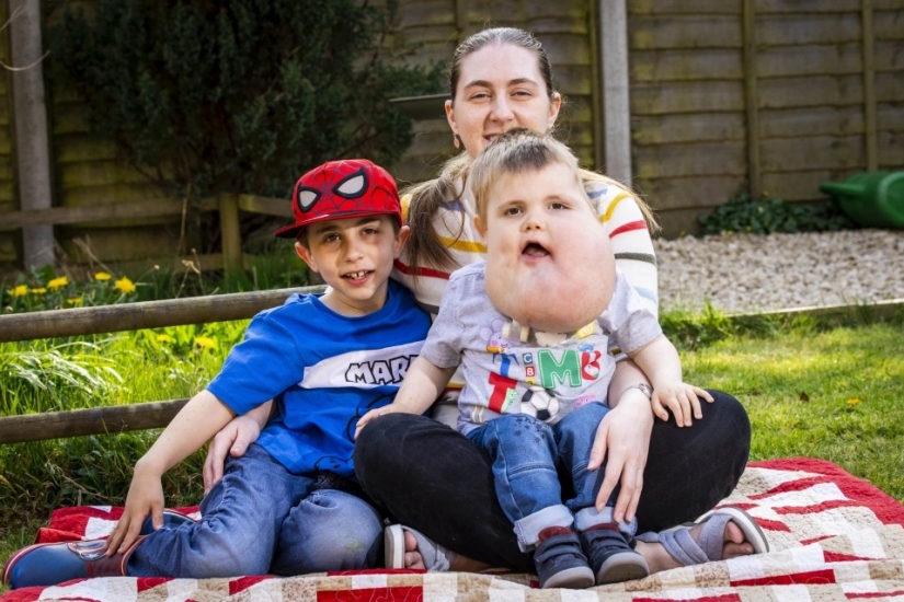 With faith in the best: a 4-year-old boy with a tumor on his face does not lose heart, despite the disease