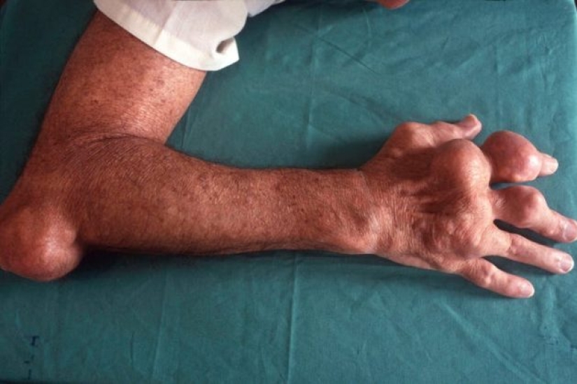 6 enfermedades peligrosas que han regresado en los últimos 10 años