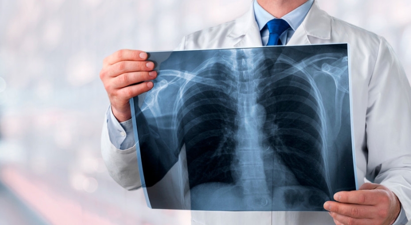 6 signs of "quiet" pneumonia that cannot be missed 6 signs of "quiet" pneumonia that cannot be missed