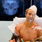 A 29-second battle: eight fractures and a skull like a hundred-year-old mummy A 29-second battle: eight fractures and a skull like a hundred-year-old mummy