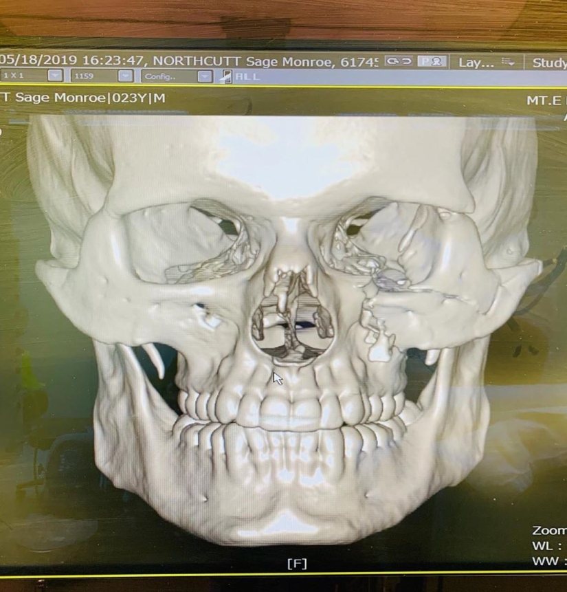 A 29-second battle: eight fractures and a skull like a hundred-year-old mummy