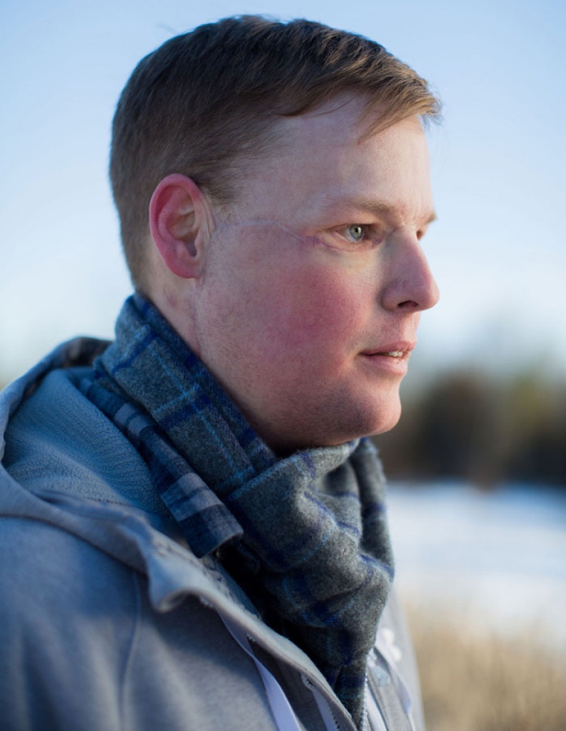 A failed suicide had his face transplanted, and a new life began for him