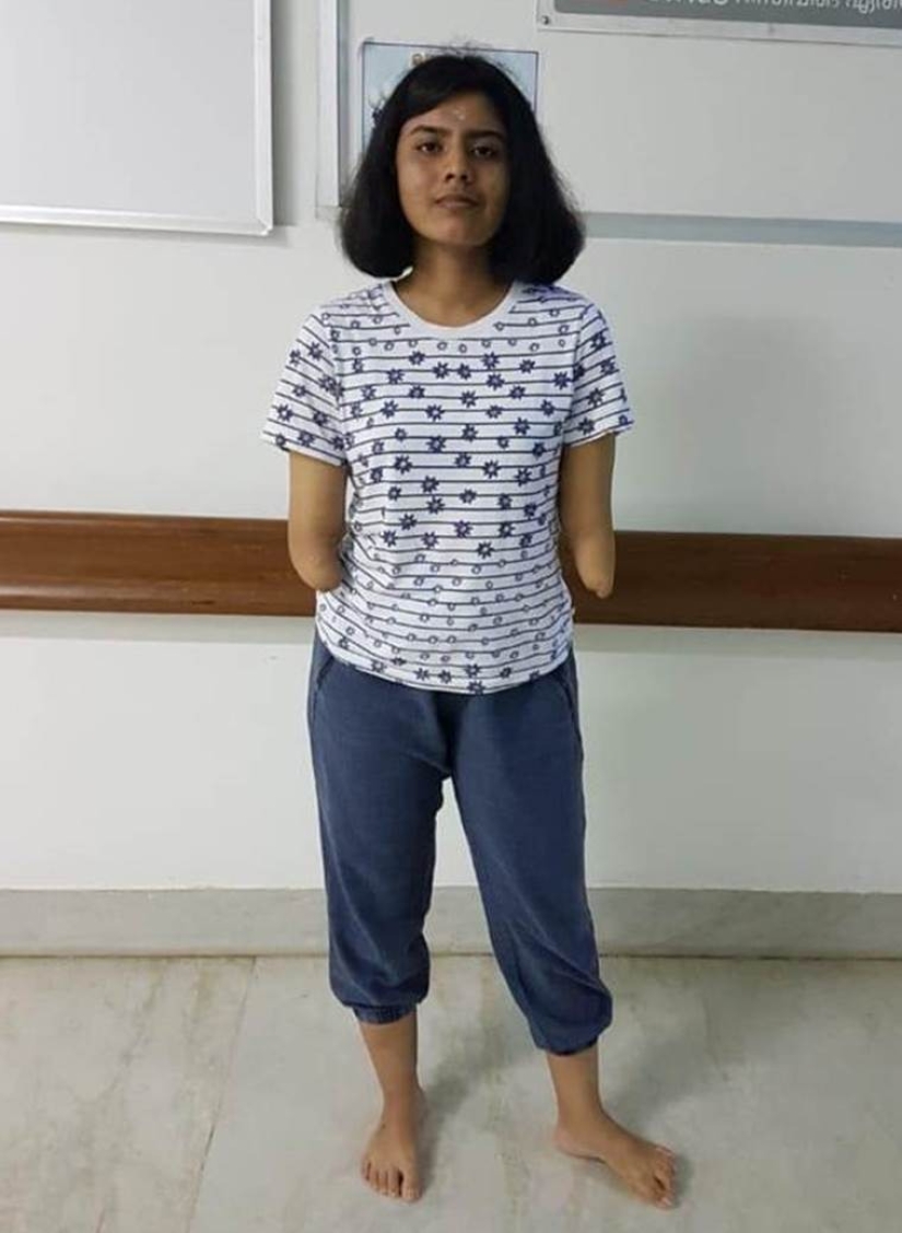A una niña de la India le trasplantaron manos masculinas, un año después se aclararon y perdieron el cabello