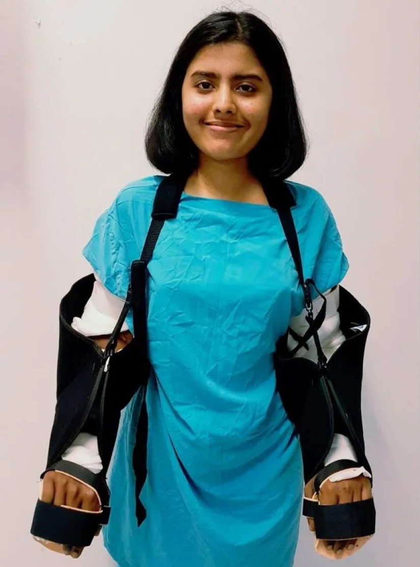 A una niña de la India le trasplantaron manos masculinas, un año después se aclararon y perdieron el cabello