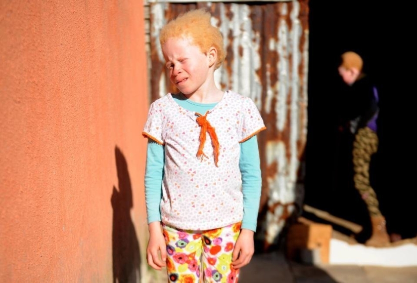 African albinos do not hide their fears African albinos do not hide their fears