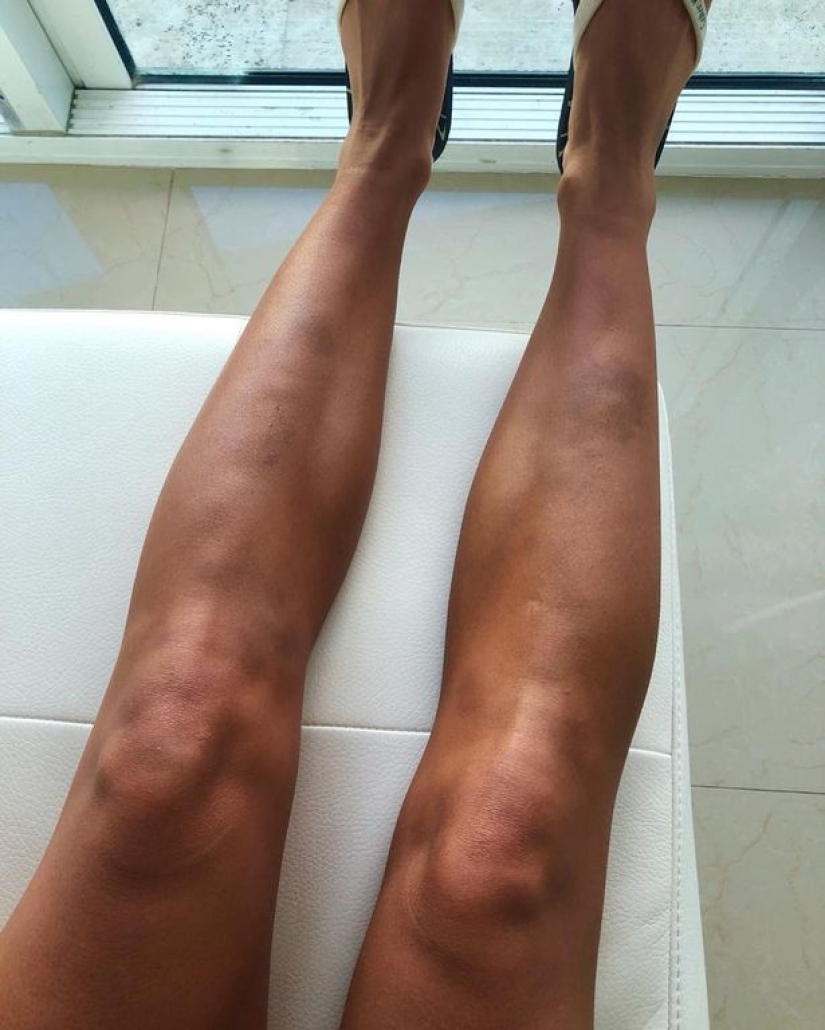 Amor golpeado: la famosa modelo sufrió palizas y humillaciones de su novio durante dos años