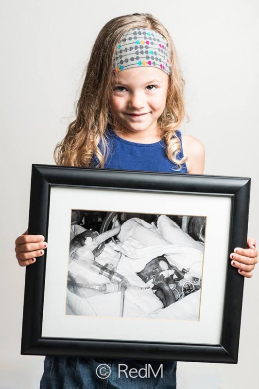 Antes y después: fotos fuertes de niños que nacieron prematuramente