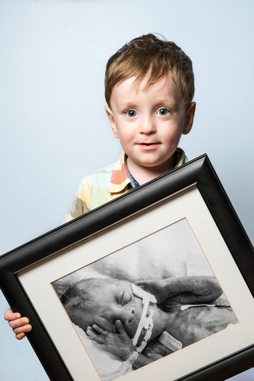 Antes y después: fotos fuertes de niños que nacieron prematuramente