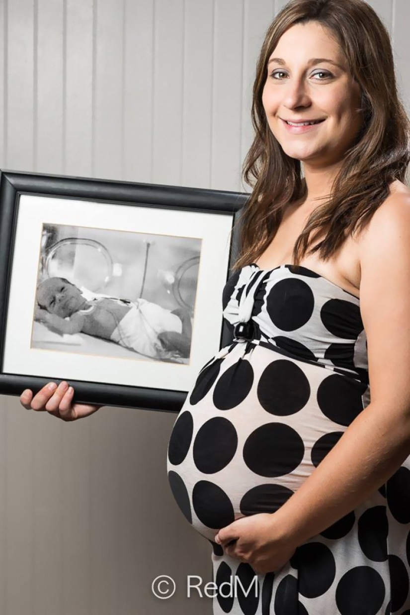 Antes y después: fotos fuertes de niños que nacieron prematuramente