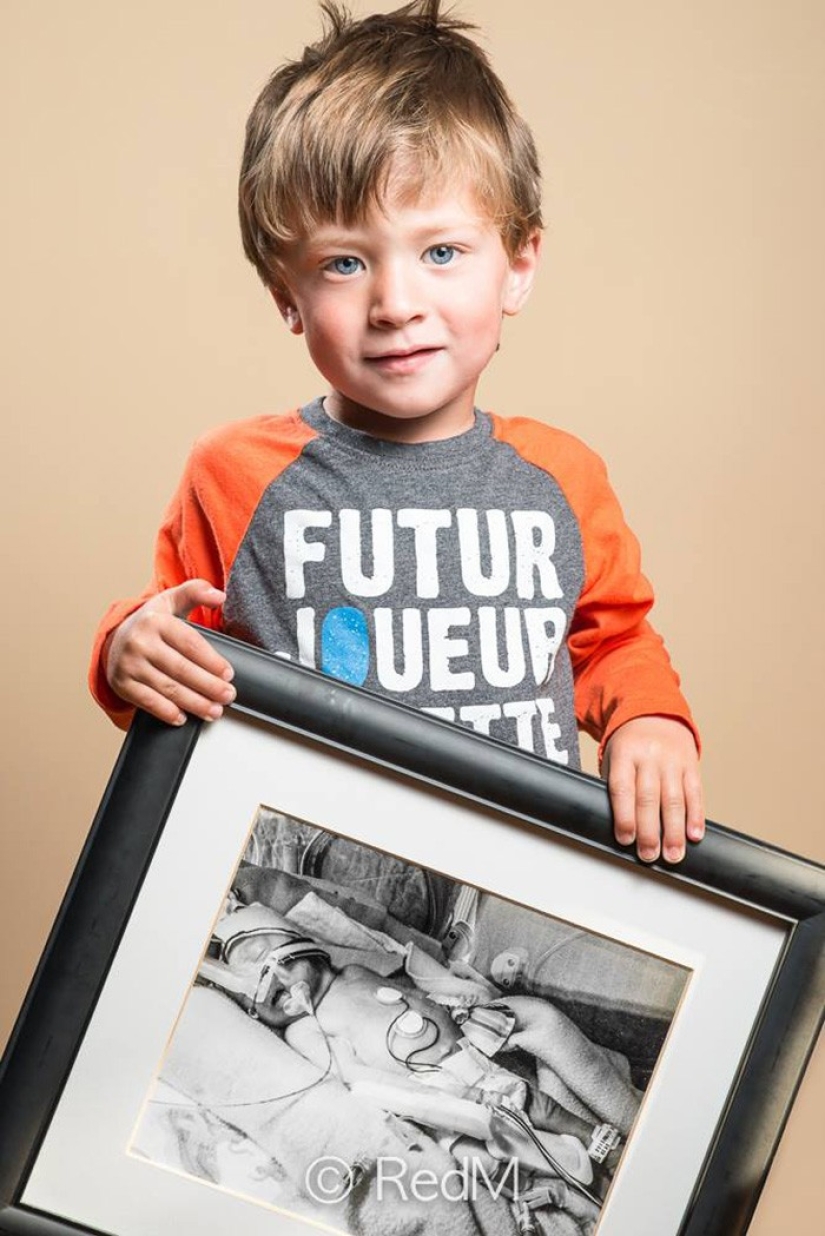 Antes y después: fotos fuertes de niños que nacieron prematuramente
