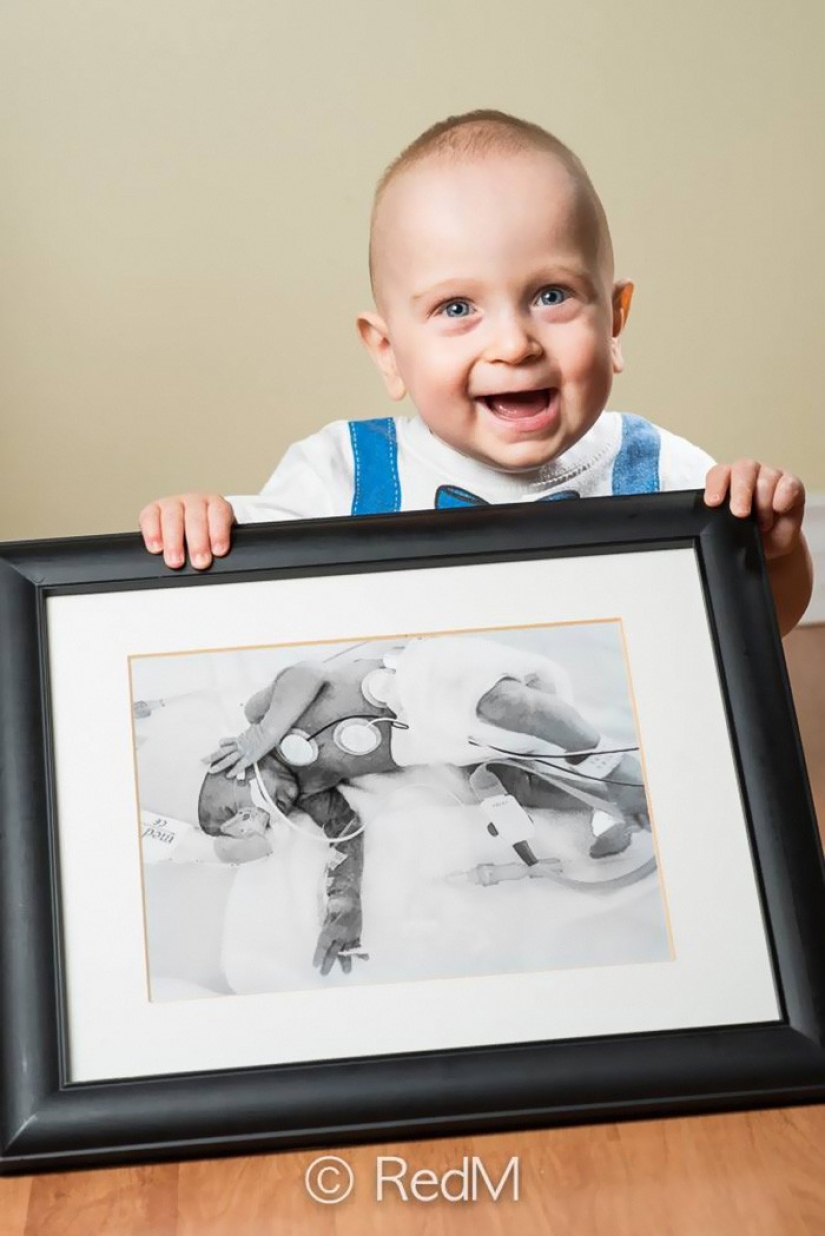 Antes y después: fotos fuertes de niños que nacieron prematuramente