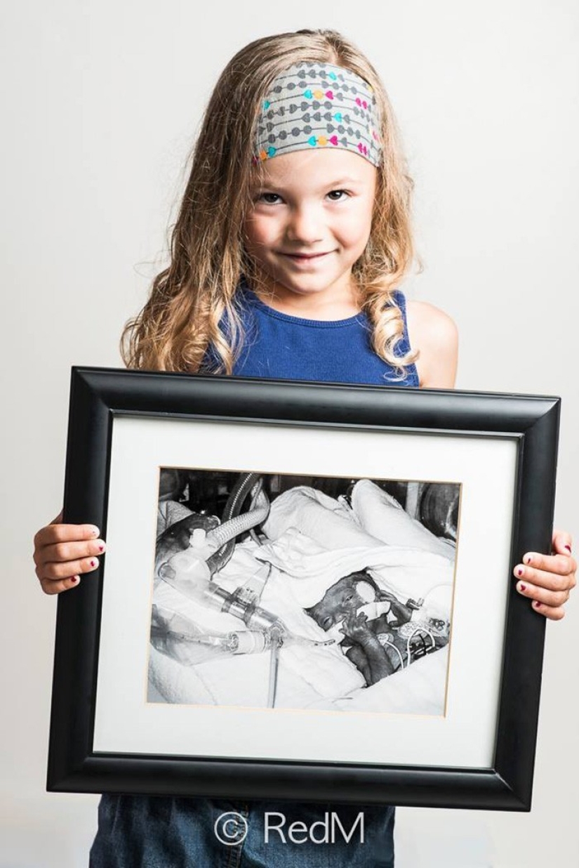 Antes y después: fotos fuertes de niños que nacieron prematuramente