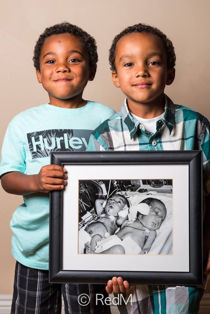 Antes y después: fotos fuertes de niños que nacieron prematuramente