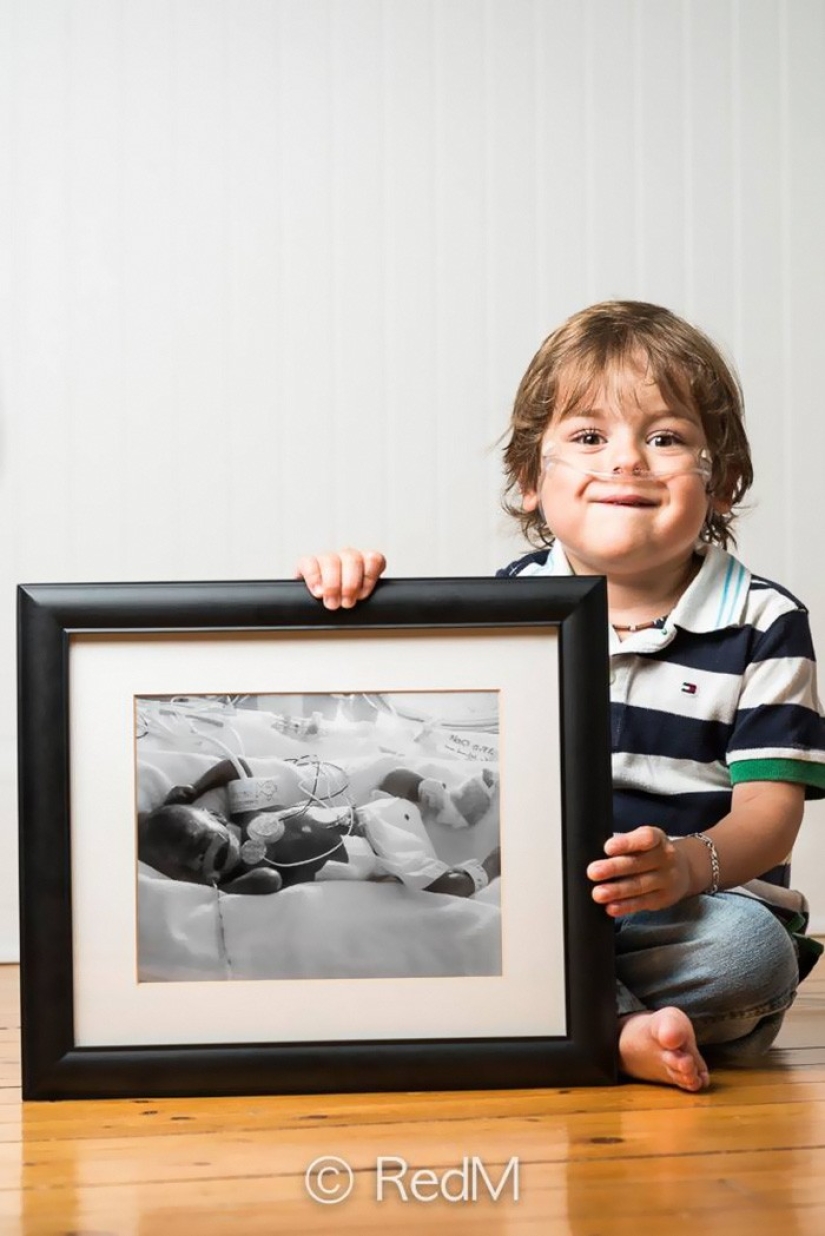 Antes y después: fotos fuertes de niños que nacieron prematuramente