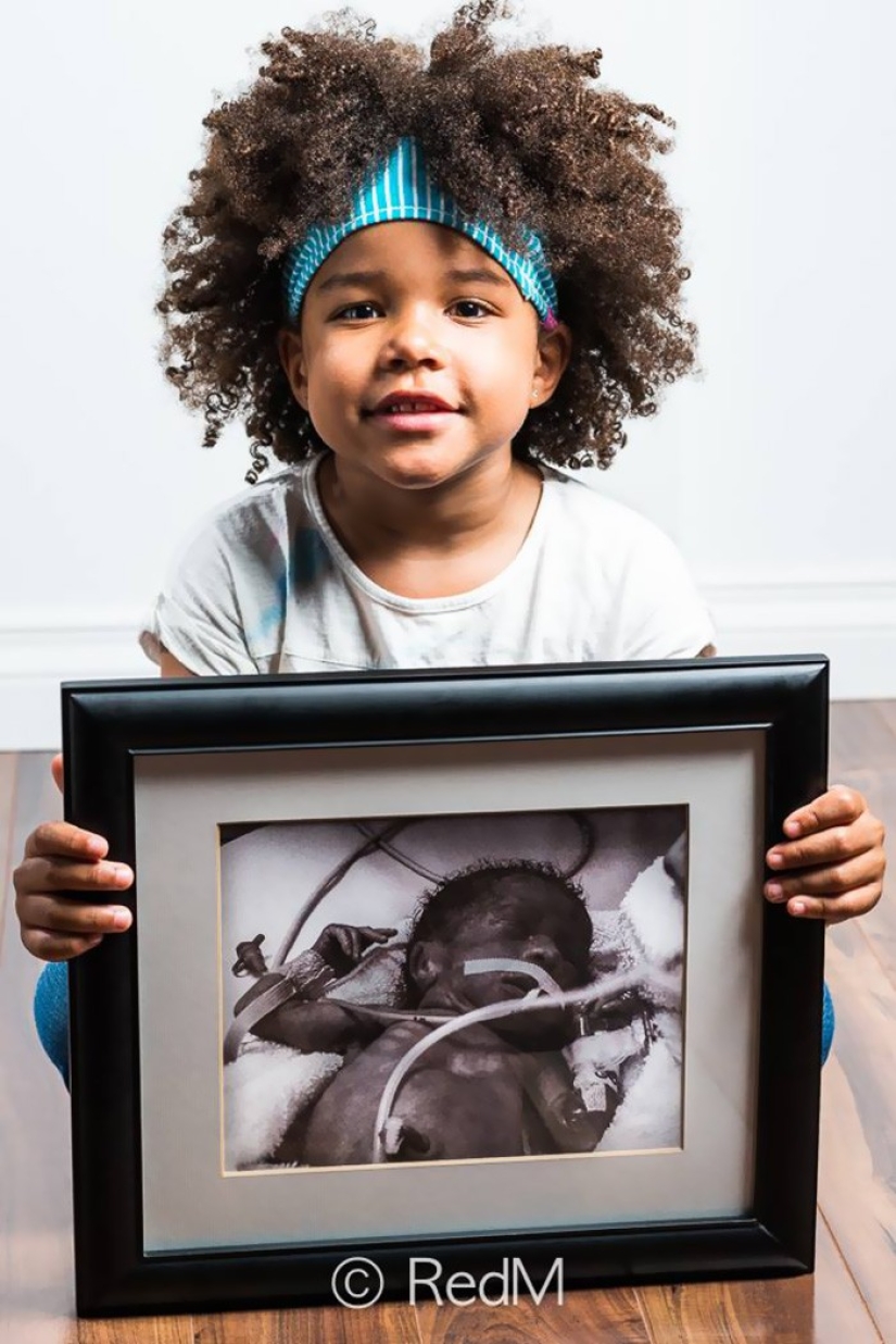 Antes y después: fotos fuertes de niños que nacieron prematuramente