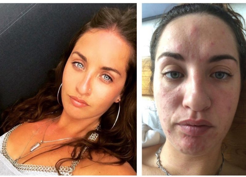 Apartment killer: the girl almost died from mold on the walls of the house Apartment killer: the girl almost died from mold on the walls of the house