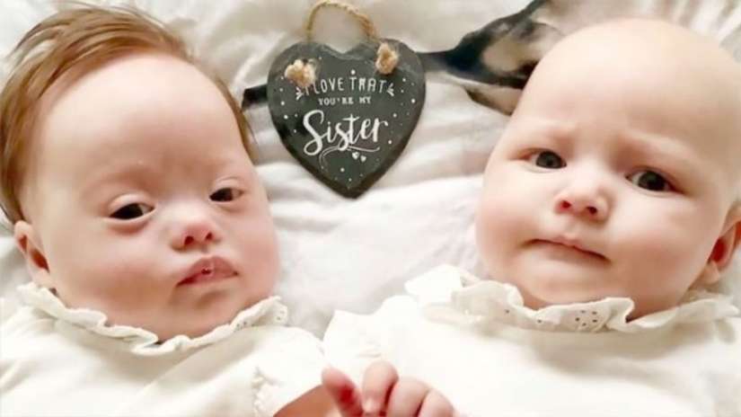 "Babies in a million": a British couple had unique twin girls "Babies in a million": a British couple had unique twin girls