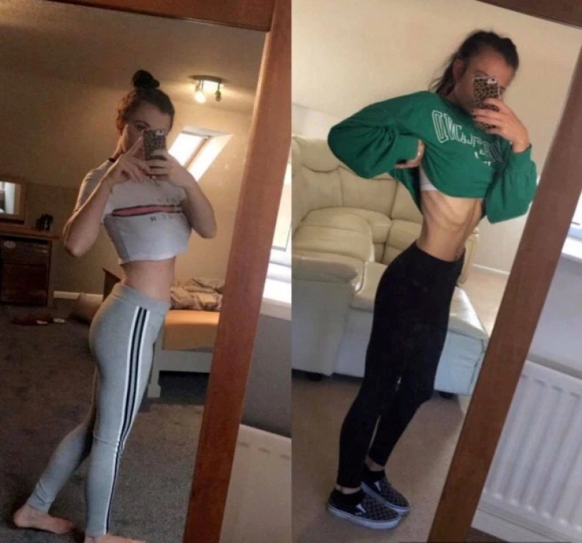 Bebida que salva vidas: las vacaciones con amigos en el resort salvaron a la niña de la anorexia