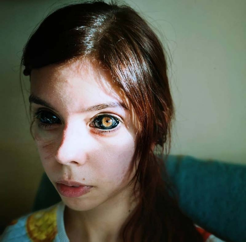Black eyes: model from Poland went blind after tattooing eyeballs Black eyes: model from Poland went blind after tattooing eyeballs