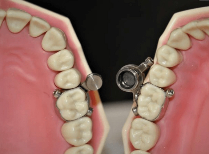 Boca cerrada: científicos de Nueva Zelanda han ideado una manera ingeniosa de perder peso