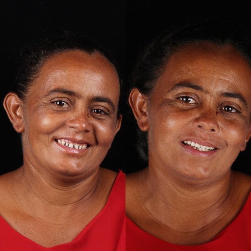 Brazilian dentist helps poor people shine with a snow-white smile