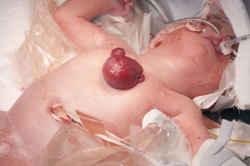 British doctors saved a baby girl who was born with her heart out British doctors saved a baby girl who was born with her heart out