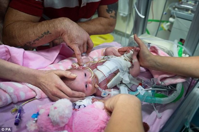British doctors saved a baby girl who was born with her heart out British doctors saved a baby girl who was born with her heart out