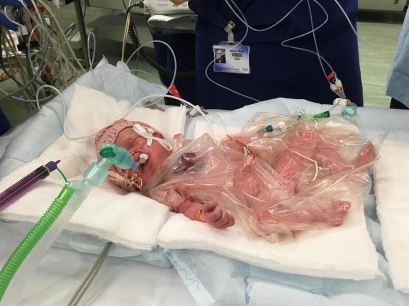 British doctors saved a baby girl who was born with her heart out British doctors saved a baby girl who was born with her heart out