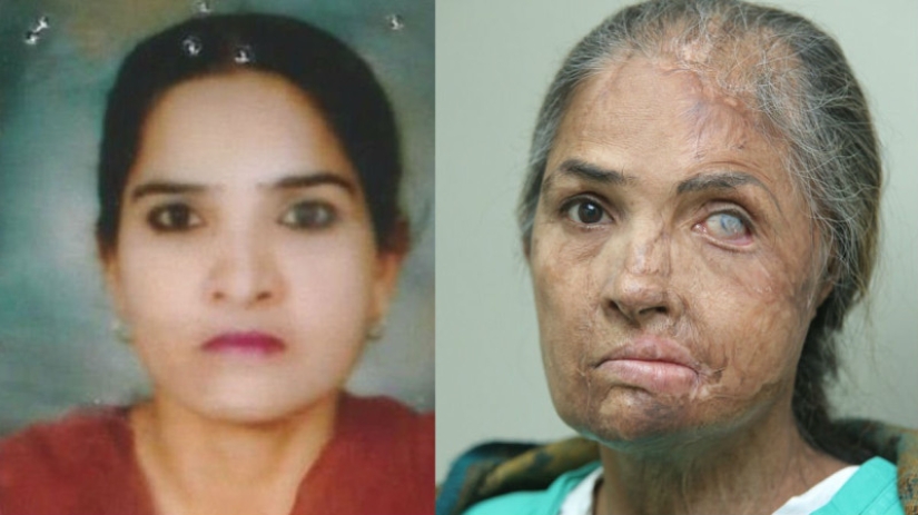 British surgeon performs free eyebrow transplantation for acid attack victims