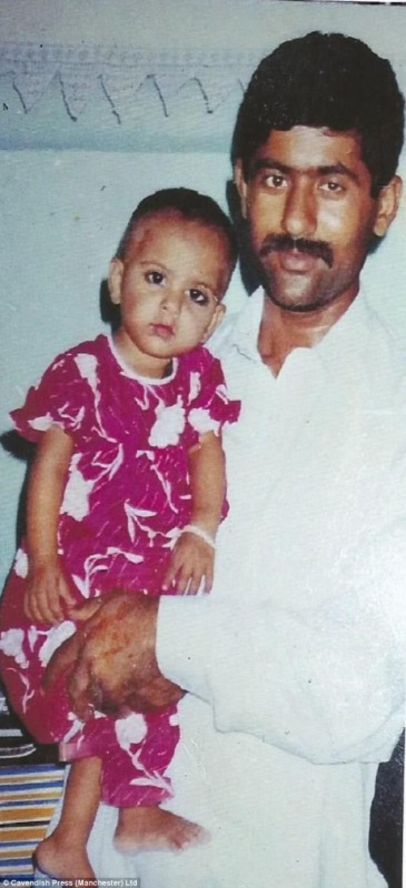 British surgeon performs free eyebrow transplantation for acid attack victims