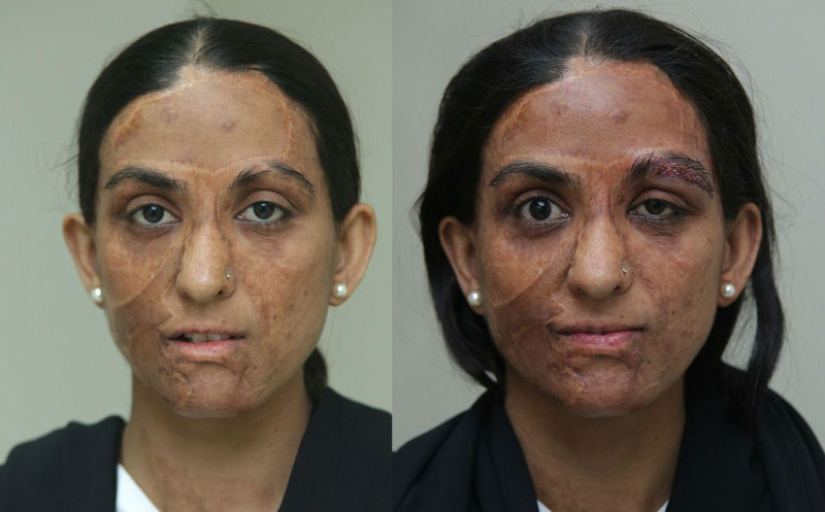 British surgeon performs free eyebrow transplantation for acid attack victims