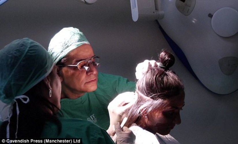 British surgeon performs free eyebrow transplantation for acid attack victims