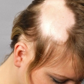 Calvas, valientes, orgullosas: mujeres que aprendieron a vivir con alopecia y se enamoraron de sí mismas sin pelo