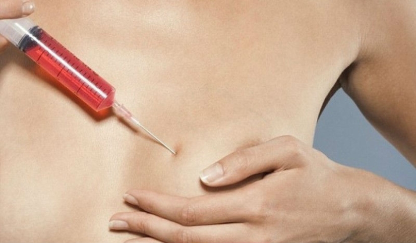 "Cinderella plastic surgery": Japanese practice breast augmentation for a day