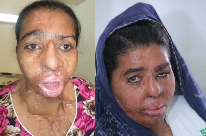 Cirujano británico realiza trasplante de cejas gratuito para víctimas de ataques con ácido