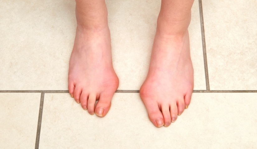 Cómo los pies muestran el estado de salud: 8 señales sobre enfermedades graves Cómo los pies muestran el estado de salud: 8 señales sobre enfermedades graves