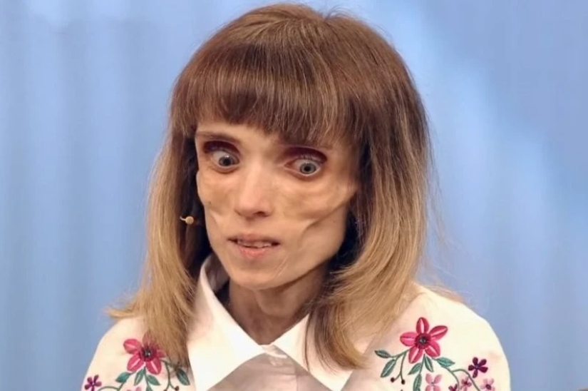 Cómo se ve ahora Kristina Koryagina — una mujer rusa que pesaba 17 kg Cómo se ve ahora Kristina Koryagina — una mujer rusa que pesaba 17 kg