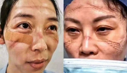 Cómo se ven las caras de los médicos chinos al final de un turno de trabajo Cómo se ven las caras de los médicos chinos al final de un turno de trabajo